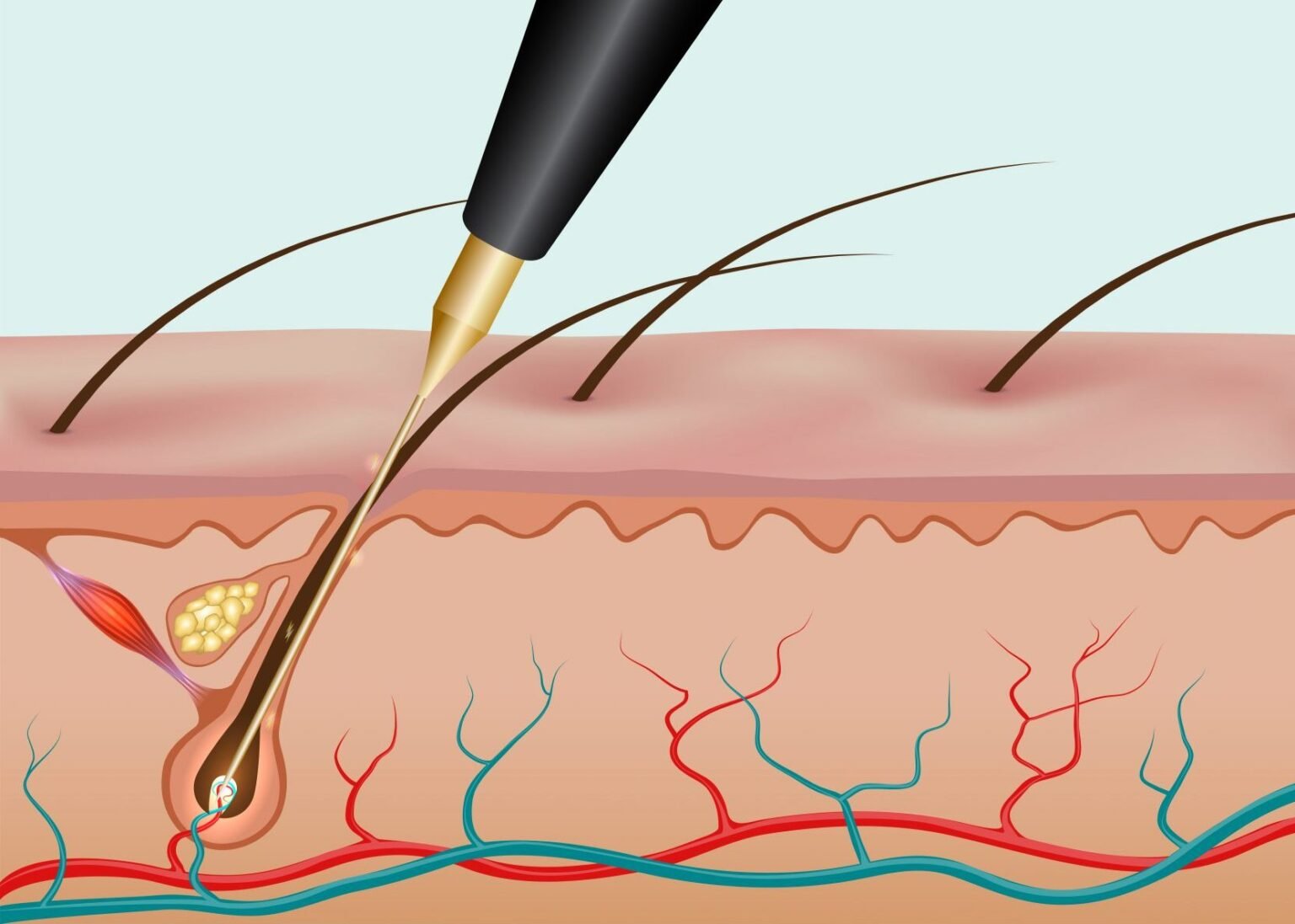 Electrodepilación